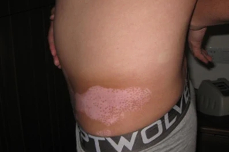 散发型白癜风腰部症状图