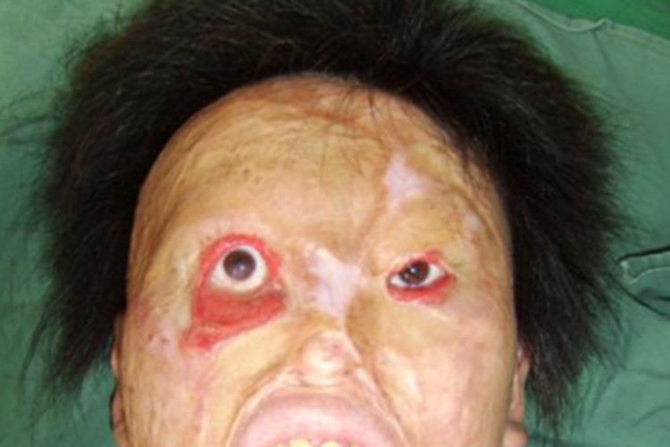 下睑外翻下睑畸形图