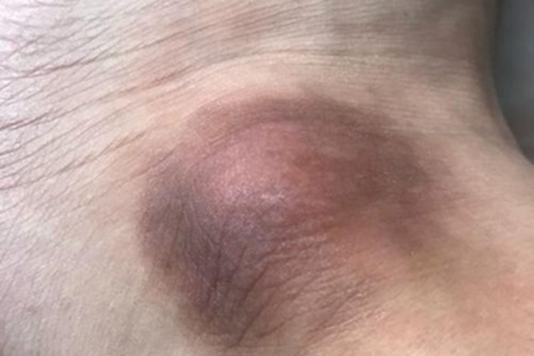 炎症后色素沉着脚踝症状图