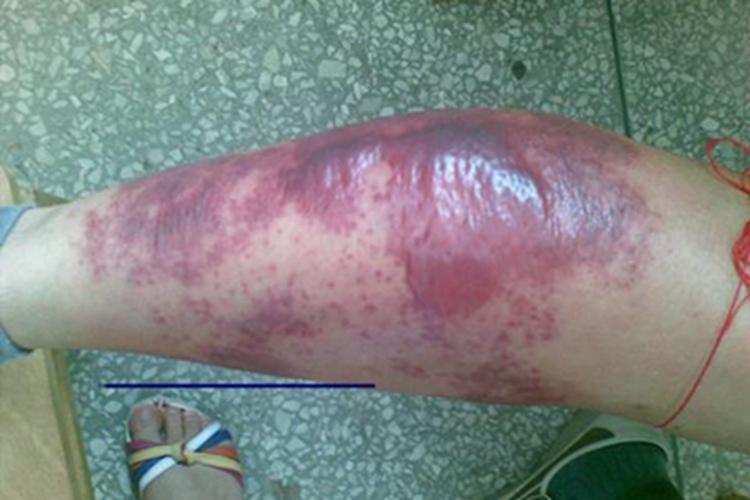 急性淋巴管炎小腿水疱图 急性淋巴管炎小腿水疱图