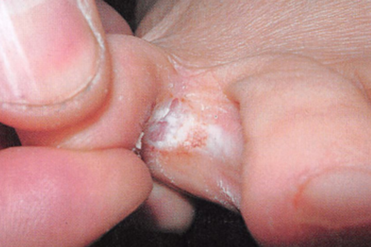 浸渍糜烂型足藓图 浸渍糜烂型足藓图