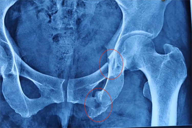 左侧耻骨上下支骨折位置图