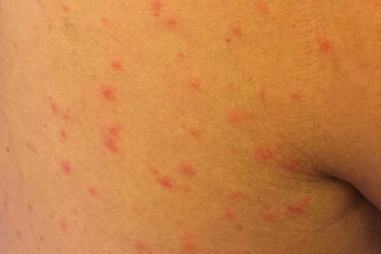 柯萨奇湿疹背部小红疙瘩图