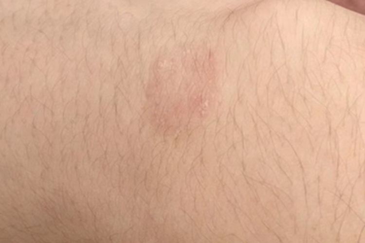 钱币状湿疹小疙瘩图 钱币状湿疹小疙瘩图