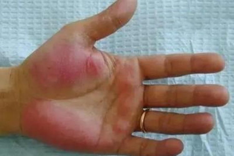 肝硬化手掌红斑图 肝硬化手掌红斑图