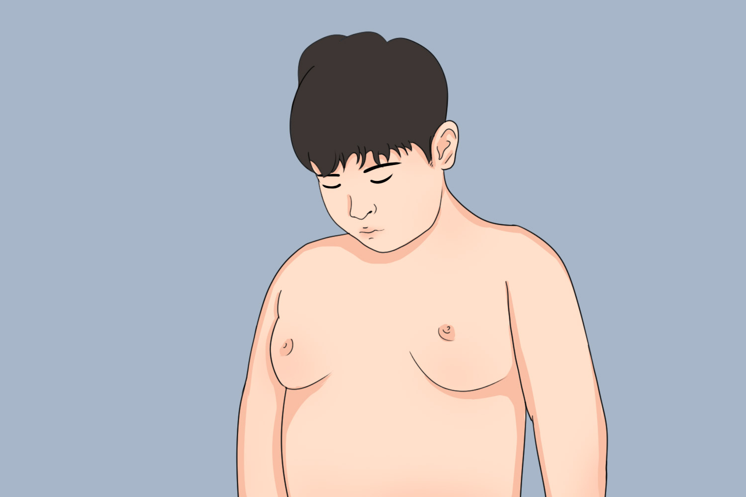 青春期乳房肥大症图 青春期乳房肥大症图