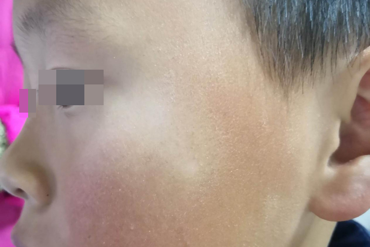 小孩贫血痣眼角白斑图