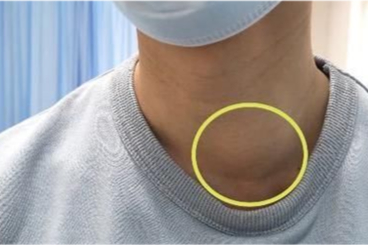 甲状腺肿大图