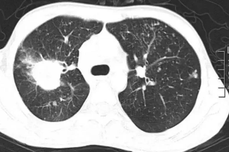 肺念珠菌病CT图 肺念珠菌病CT图