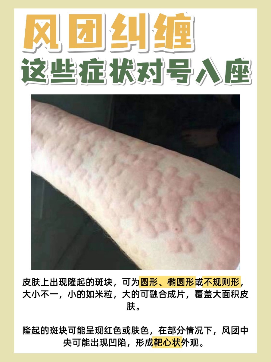 风团纠缠，这些症状对号入座