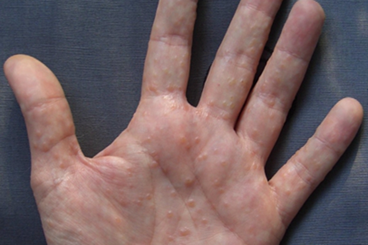 手部汗疱疹图 手部汗疱疹图