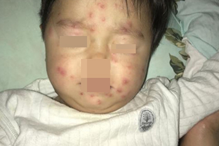 水痘面部丘疹图