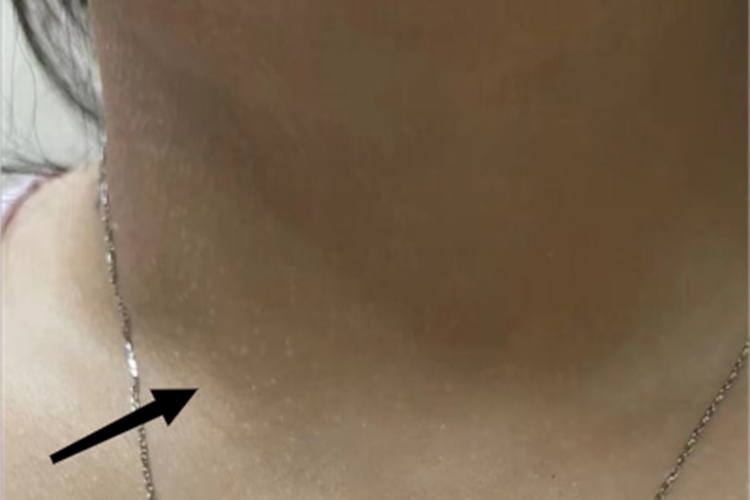 光泽苔藓前颈症状图 光泽苔藓前颈症状图