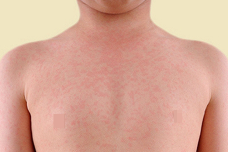 胆碱能性荨麻疹胸部丘疹图