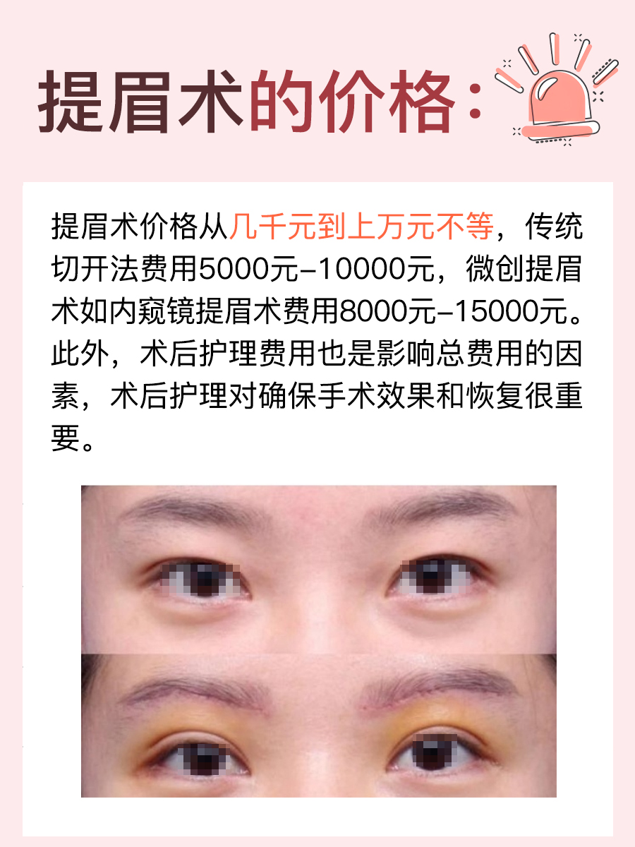 揭晓！提眉术的价格是多少