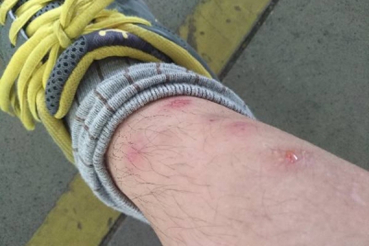 螨虫皮炎小腿丘疹图 螨虫皮炎小腿丘疹图