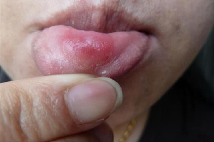 白塞病唇内侧红肿图 白塞病唇内侧红肿图