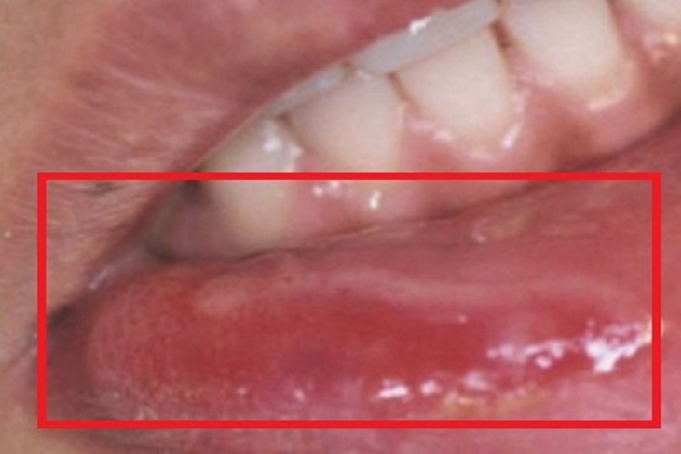 梅毒性唇下疳红肿图