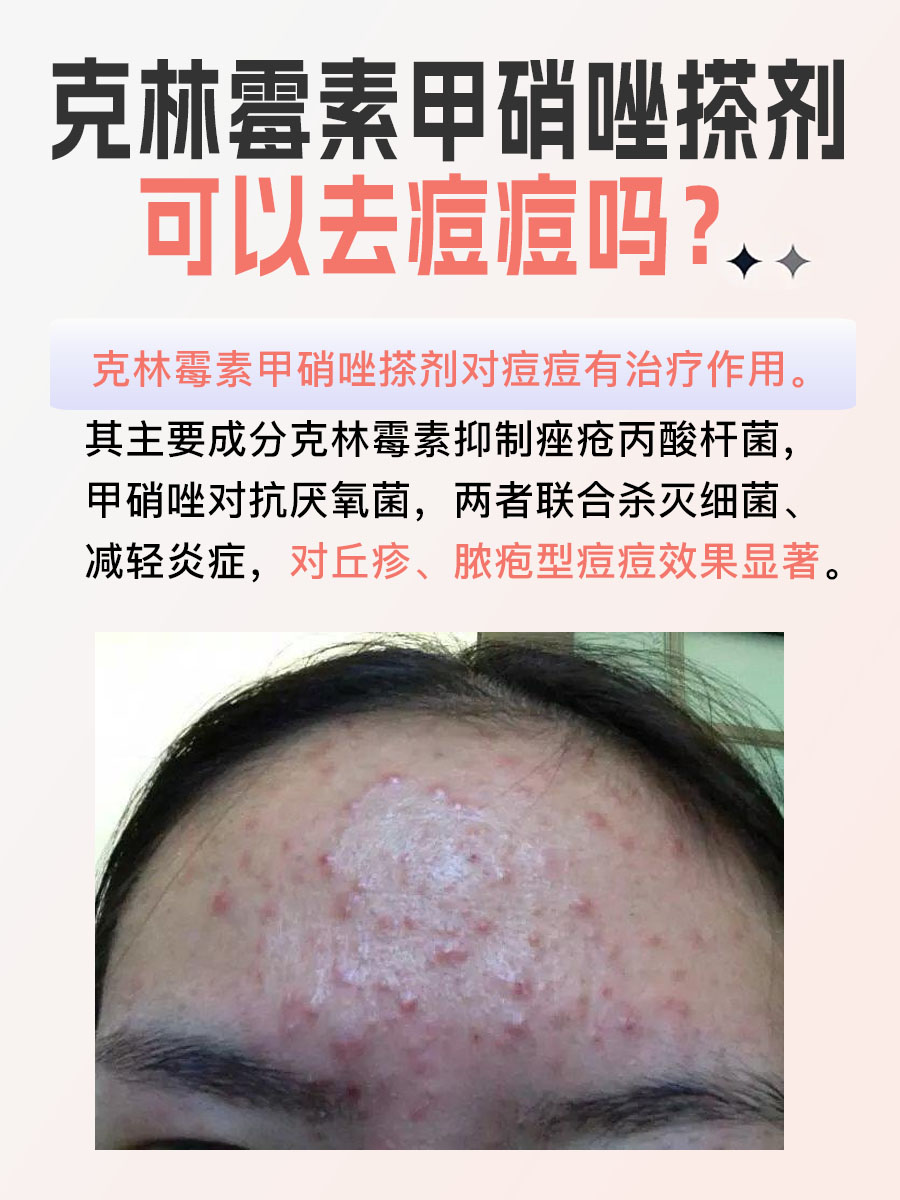 克林霉素甲硝唑搽剂可以去痘痘吗？一文解析