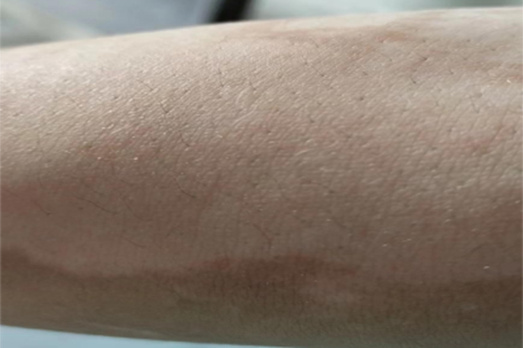 白癜风小腿皮肤颜色变浅图