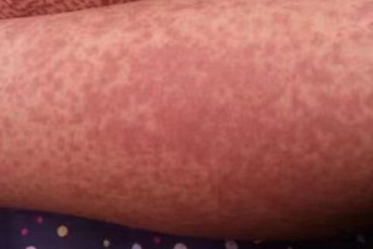 血栓性血小板减少性紫癜红点图 血栓性血小板减少性紫癜红点图