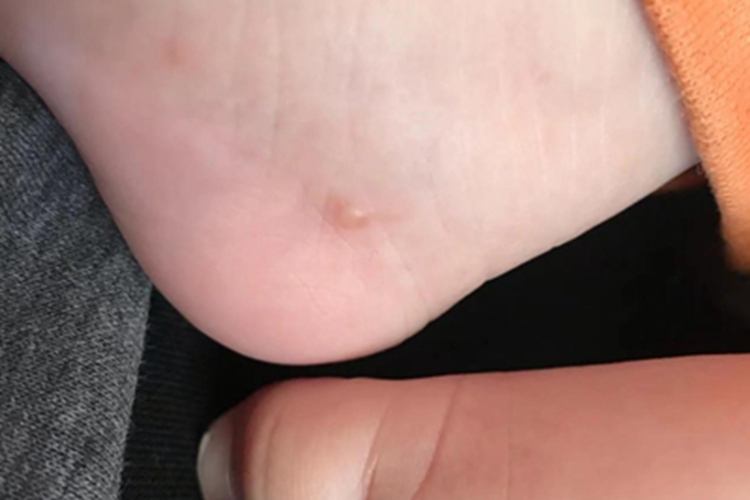 水痘脚后跟起一个小水疱图