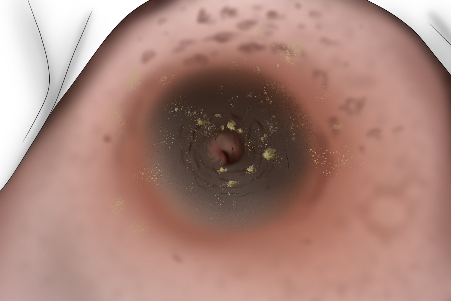 乳房糜烂渗出图