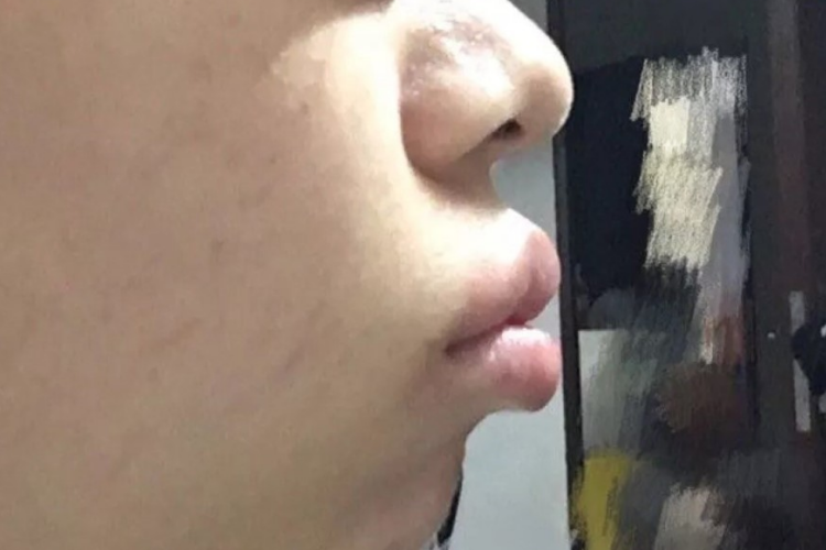 龅牙双颌前突畸形图 龅牙双颌前突畸形图