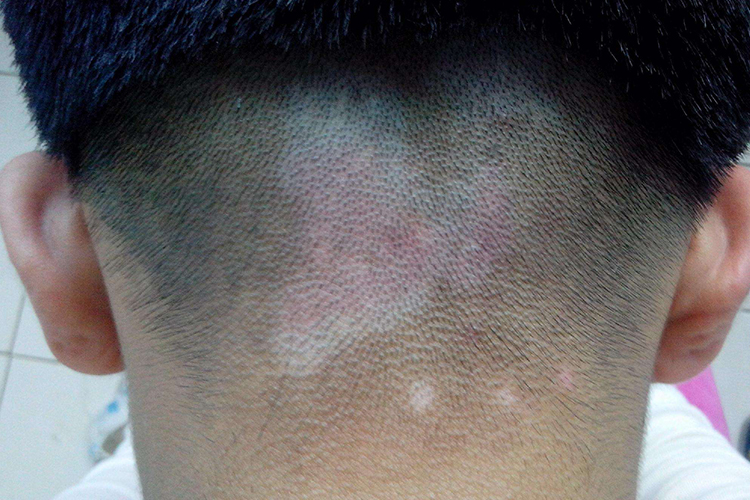 后脑勺头皮白癜风图