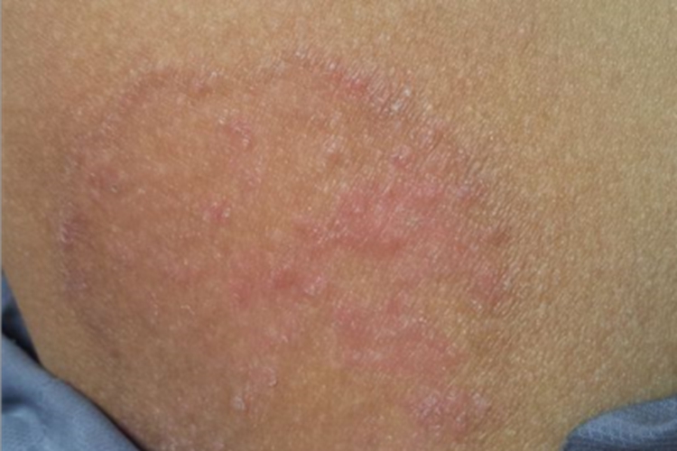 股癣大腿根环形红斑有疙瘩图