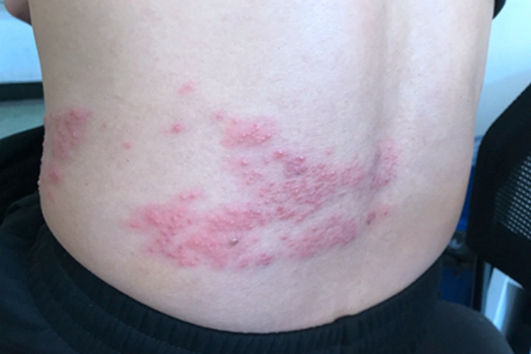 带状疱疹后背起了好多水疱图 带状疱疹后背起了好多水疱图