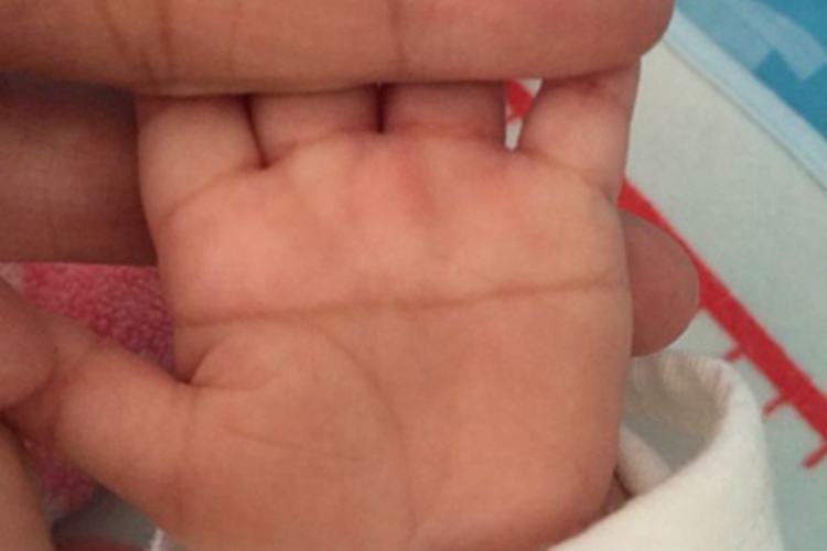 5P-综合征手掌纹图