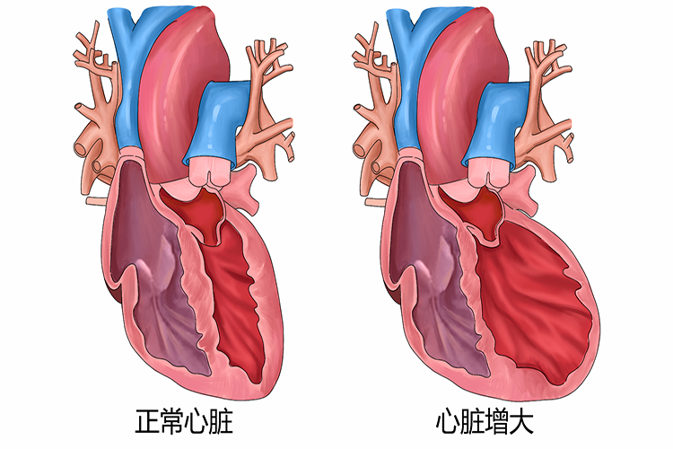 正常心脏vs心脏增大