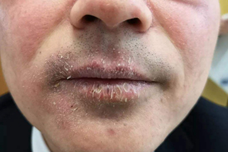 剥脱性唇炎症状图 剥脱性唇炎症状图