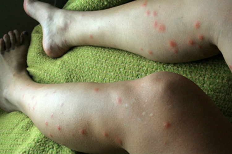 恙螨皮炎疙瘩图