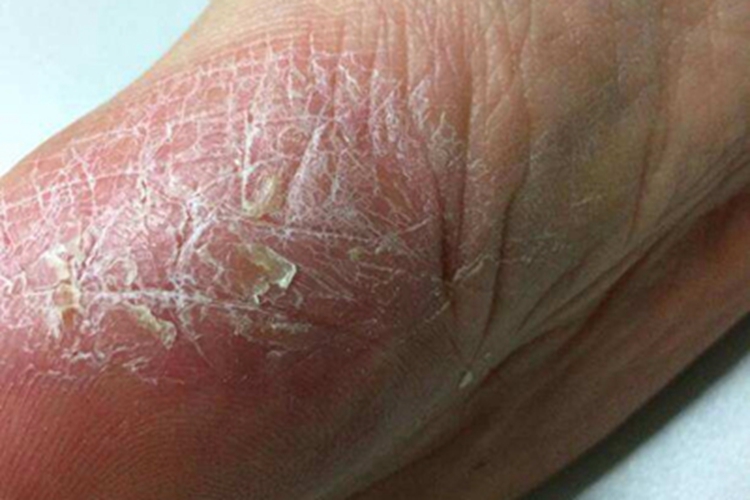 更年期角皮症脚部皮肤增厚图