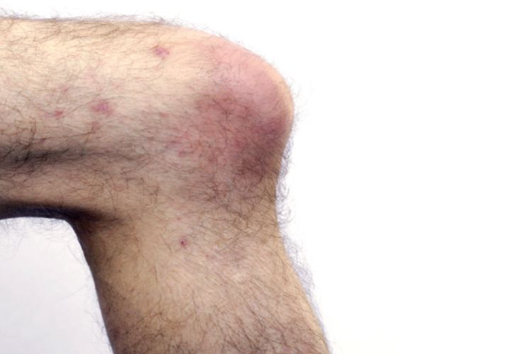 红斑狼疮腿上红斑图 红斑狼疮腿上红斑图