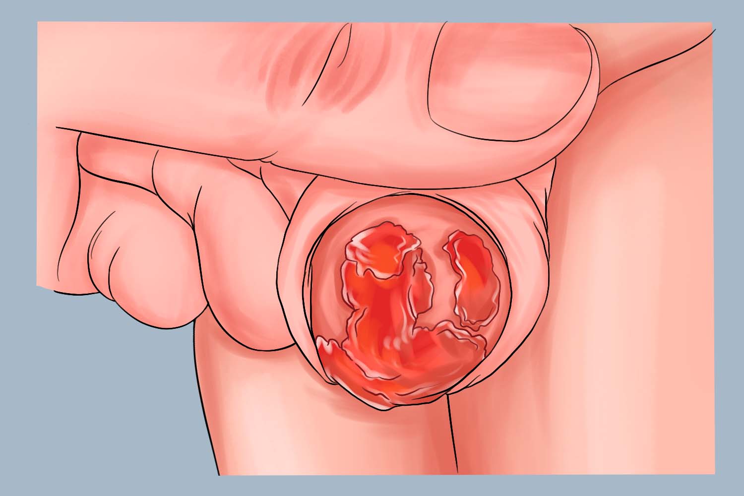 阿米巴性包皮龟头炎图