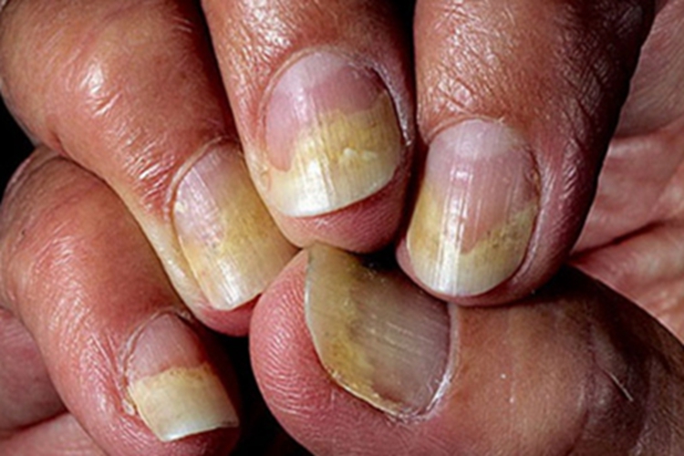 银屑病甲手指甲上翘图
