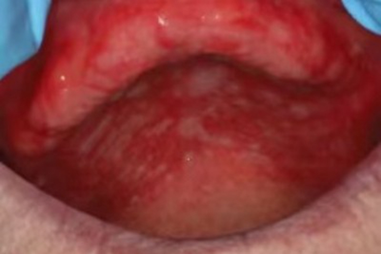 药物过敏性口炎口腔溃疡图