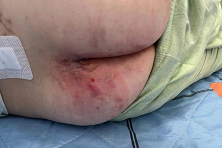 水疱期压疮糜烂图 水疱期压疮糜烂图