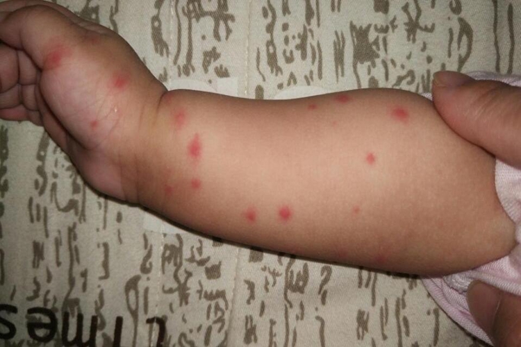 宝宝胳膊蚊虫叮咬图