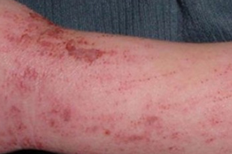 凡士林过敏后抓挠的溃疡图