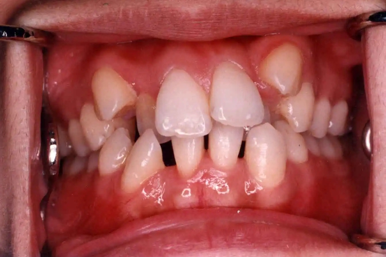 可表现为牙列拥挤,左右牙弓不对称,常常伴有牙错位,咬合关系不佳等