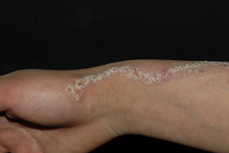 线状疣状表皮痣脱屑图