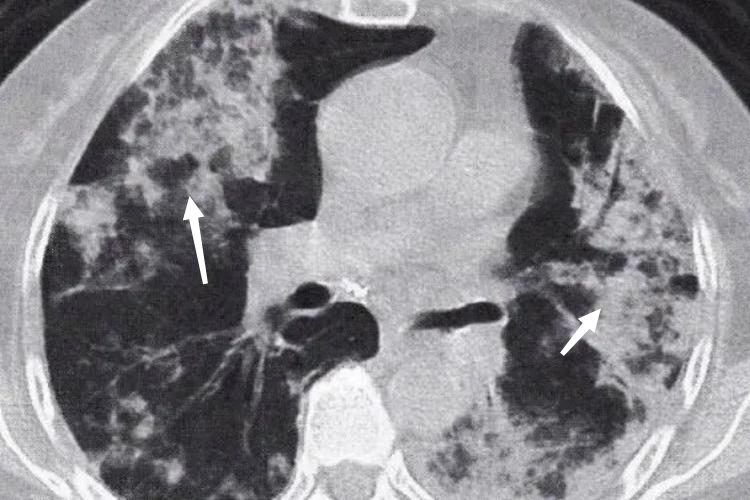 弥漫型肺癌CT图