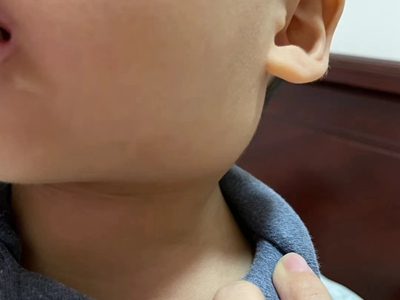 儿童复发性腮腺炎耳朵下边肿起来一块图