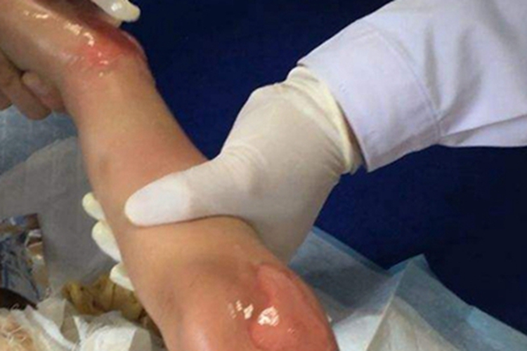 浅Ⅱ度烧伤腿红肿图