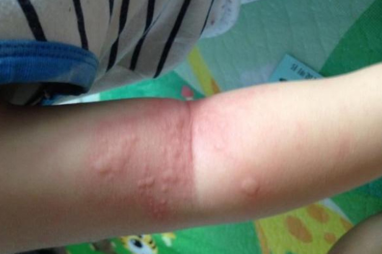 宝宝胳膊急性自发性荨麻疹图