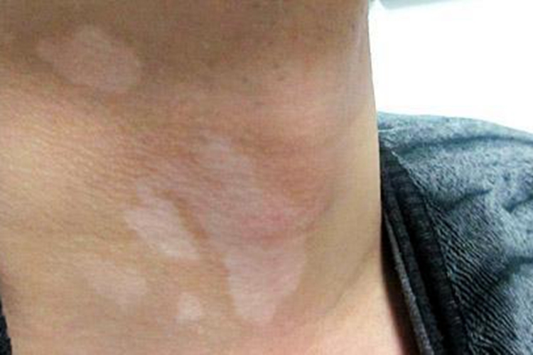 脖子白癜风图 脖子白癜风图